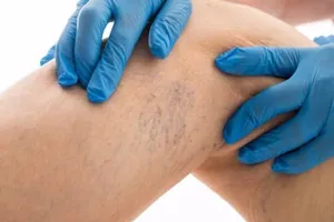 Bí quyết giúp giảm đau do giãn tĩnh mạch chân