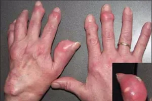 Thuốc nào tăng nguy cơ mắc bệnh gút?