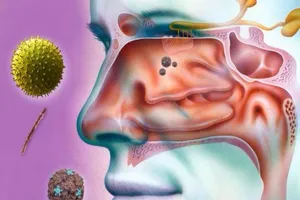 4 cách hiệu quả giúp làm dịu viêm xoang