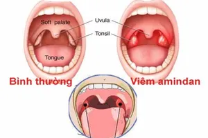 Viêm amidan, khi nào nên cắt?