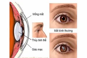 Bị đục thủy tinh thể, khi nào cần mổ?