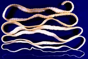 Lấy sán xơ mít dài 5 m trong bụng cụ bà 82 tuổi