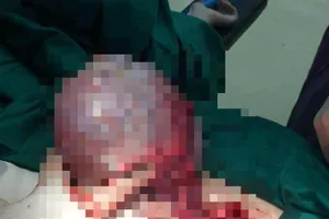 Tưởng béo bụng, hóa ra mang trong mình khối u khủng
