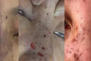 Bắt quả tang ‘bác sĩ' Hàn Quốc làm đẹp chui ở khách sạn