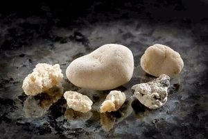 Những cách chữa sỏi thận tự nhiên rất hiệu quả