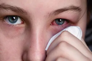 Mẹo nhỏ bỏ túi tránh viêm mắt, đỏ mắt trong mùa hè