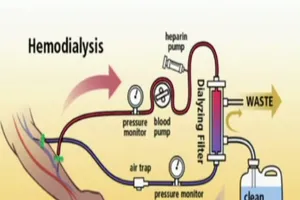 Nước chạy thận không tinh khiết sẽ nguy hiểm thế nào?