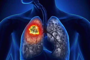 5 bệnh chết chóc ở nam giới thường phát hiện rất trễ