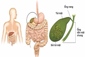 Sỏi mật do đâu mà có?
