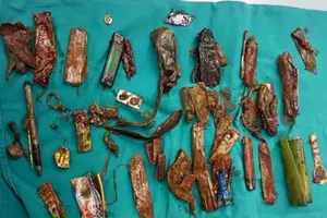 Lấy bật lửa, bút bi, vỏ kẹo... trong bụng bệnh nhân