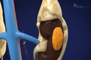 Khối u ở thận được cắt bỏ như thế nào?