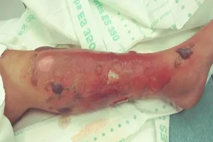 Suýt bị vi khuẩn ăn thịt người 'ăn' mất chân