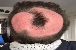 Trọc đầu vĩnh viễn vì thuốc nhuộm tóc giá rẻ