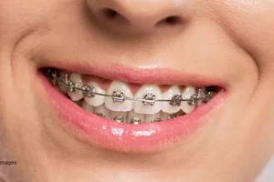 Nuốt dây niềng răng vào bụng suốt 10 năm mà không biết