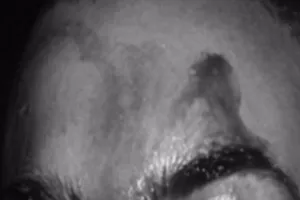 Bệnh hiếm: Mồ hôi máu, 10 triệu người có 1 người mắc