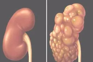 Bệnh thận đa nang và các biến chứng