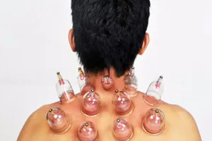 Ðau lưng mạn tính có nên giác hơi?