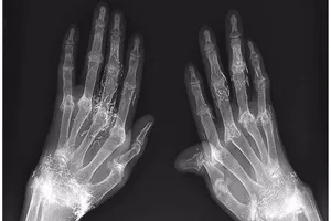 Dùng vàng khâu khớp tay để trị thấp khớp