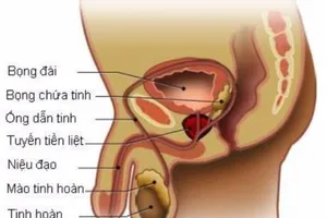 Hướng dẫn tự khám để phát hiện sớm ung thư tinh hoàn