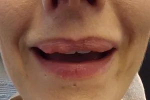 Miệng méo xệch do tiêm chất đầy môi ở tiệm làm tóc