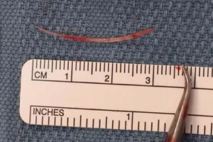 Hóc xương cá, cụ bà thoát chết trong gang tấc 