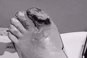 Ngón chân ‘nổ tung’ sau khi đá phải cạnh bàn 