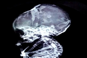 Phát hiện thai nhi ‘hóa thạch’ trong bụng mẹ 