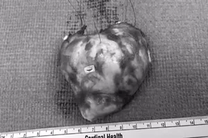 Phẫu thuật cắt khối u tim lớn nhất thế giới