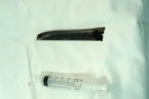 Lấy lưỡi dao dài 12 cm nằm 4 năm trong cơ thể bệnh nhân