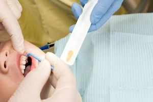 Thử nghiệm nhuộm răng đen để chống sâu răng