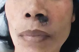 Nốt ruồi nho nhỏ mà gây họa lớn