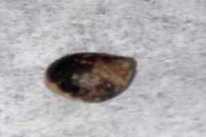 Ốc lớn lên trong cơ thể người qua vết thương