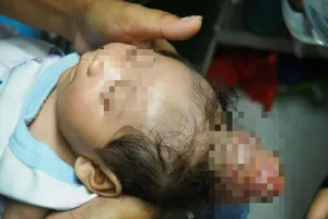 Cậu bé mọc 'sừng' trên đầu như kỳ lân