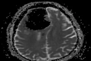 Chóng mặt, vấp ngã liên tục do khối u ‘ăn’ mất não