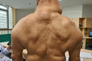 Biến thành ‘quái vật’ vì uống rượu suốt 30 năm