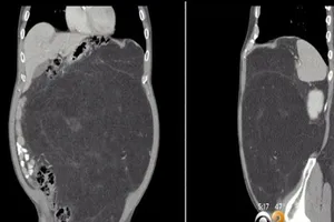 Tưởng 'bụng bia', hóa ra khối u 'khủng' 13 kg