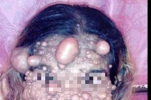 Người phụ nữ nổi u như bong bóng khắp người 