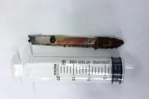 Lưỡi dao bị 'bỏ quên' trong... lưng bệnh nhân 11 năm