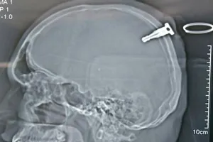 Bị chìa khóa xe máy cắm sâu vào đầu khi ẩu đả