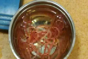 Kinh hoàng phát hiện hơn một tá giun trong ống mật