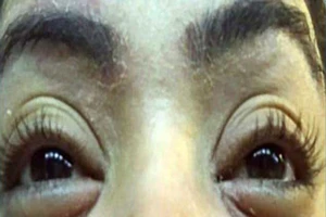 Hàng chục người nhiễm bọ ve trên mí mắt do nối mi