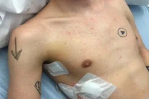 Suýt bị phẫu thuật nhầm vì hình xăm mũi tên trên ngực