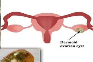 Phẫu thuật lấy khối u ‘quái vật’ đầy răng và tóc