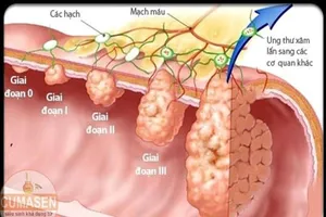 6 triệu chứng thầm lặng của ung thư đại tràng