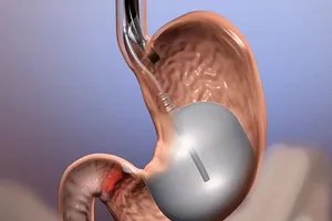 12 người chết do nuốt bóng vào bụng để giảm cân