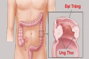 Thủ phạm gây ung thư đại trực tràng bạn có thể tránh