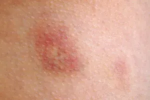 10 biểu hiện lạ trên da có thể là dấu hiệu bệnh nghiêm trọng