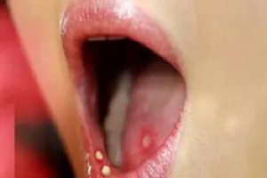 Cách đơn giản đẩy lùi nhiệt miệng