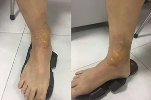 Đi massage, quý ông bị bỏng nặng phải nhập viện 