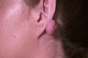 Mang 2 cục u khổng lồ sau khi xỏ lỗ tai